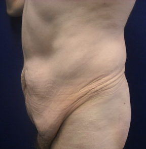 Chicago Abdominoplasty Tummy Tuck 